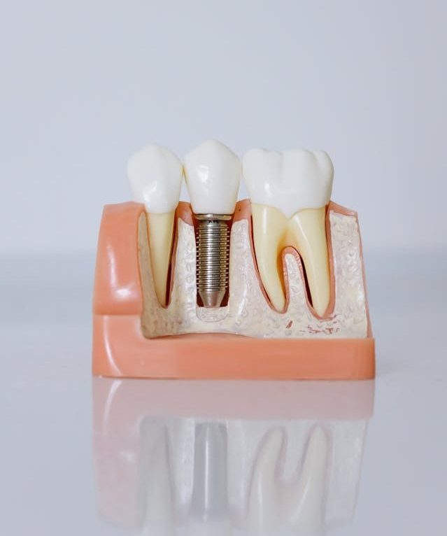dental implants irvine
