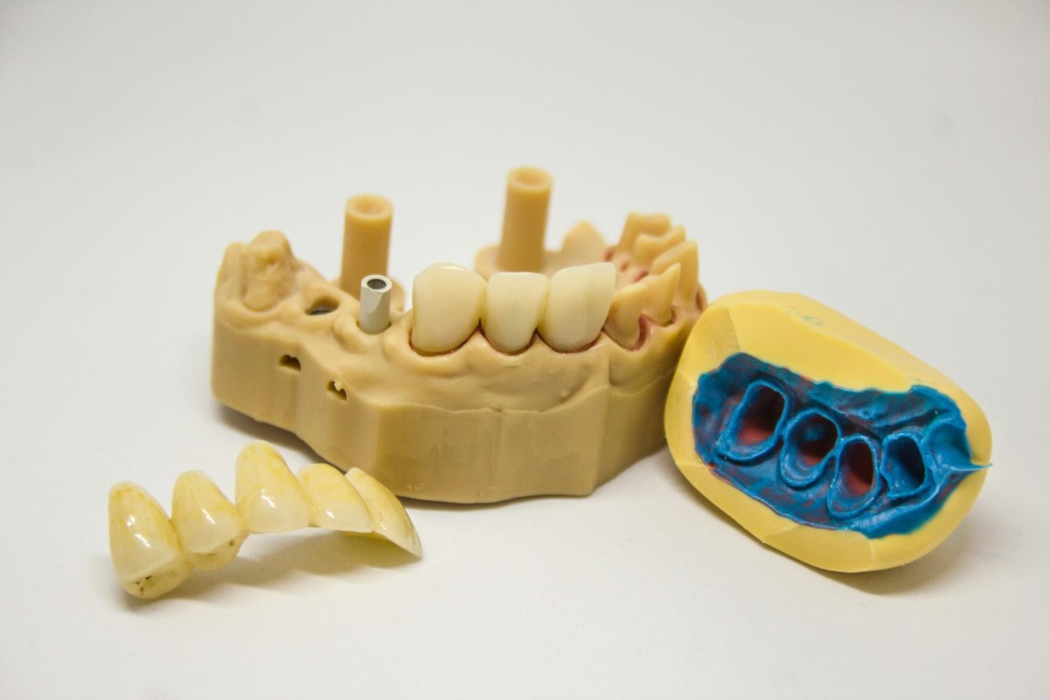Dental crown procedure model illustrating crown fabrication and placement steps