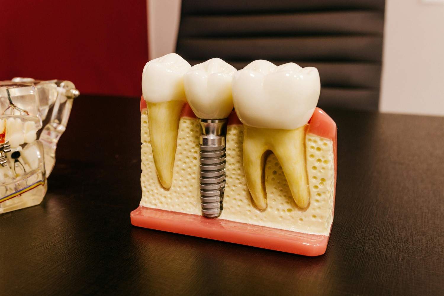 Dental implant diagram showing a titanium implant supporting a replacement tooth next to natural teeth