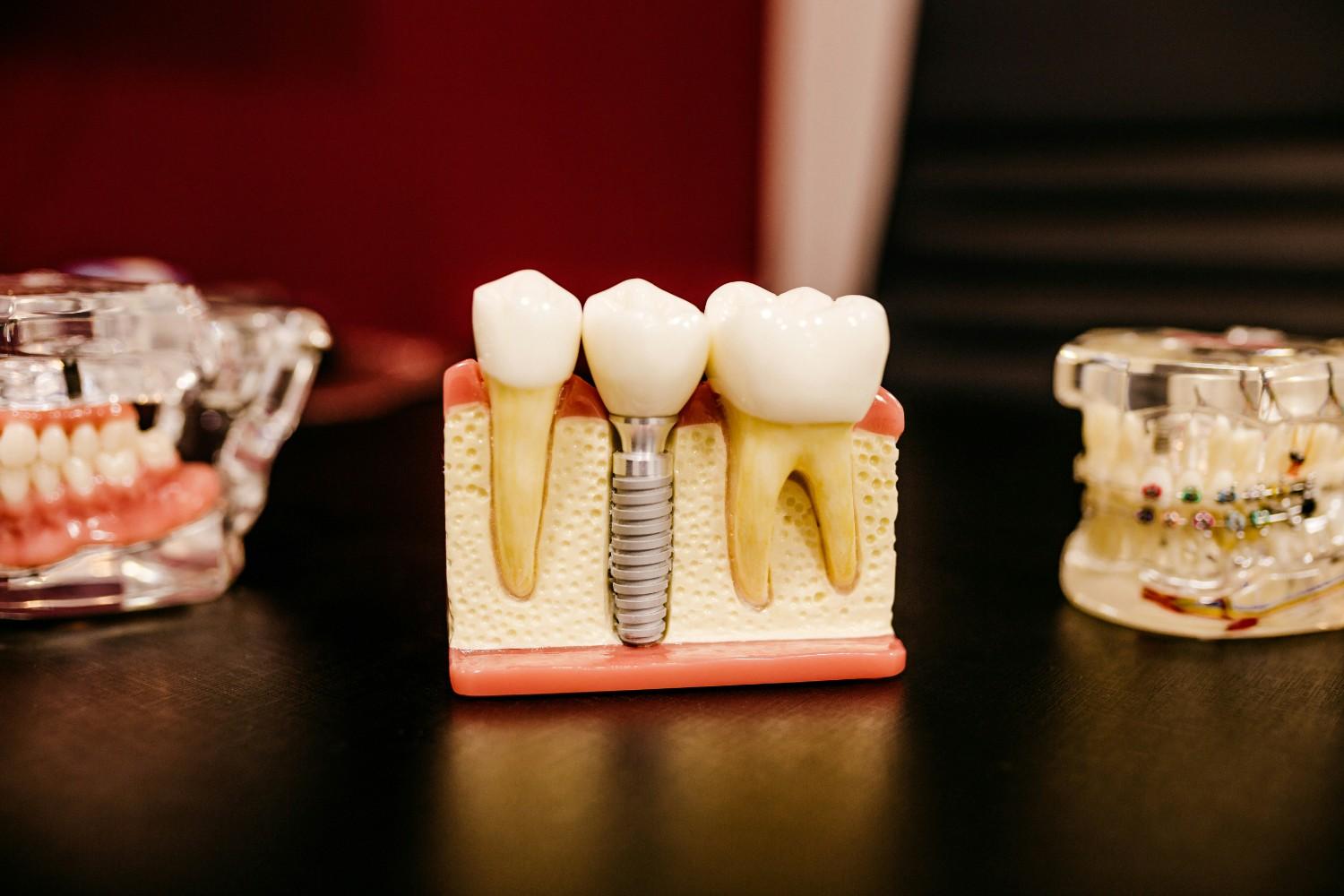 Dental implant model showing a single tooth implant next to natural teeth, illustrating partial vs full mouth dental implants
