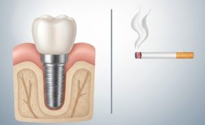 Cross-sectional illustration of a single dental implant in the jaw next to a lit cigarette, representing dental implant success rates and risks for smokers. Can Smokers Get Dental Implants?