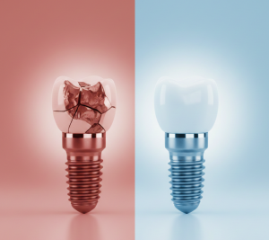 how cheap dental implants can cost you more in the long run