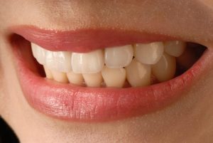 porcelain vs composite veneers thumbnail