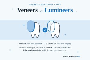 veneers vs lumineers