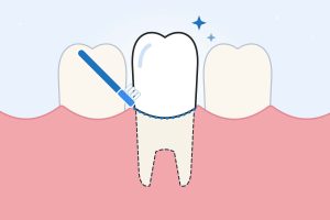 how to take care of your crowns
